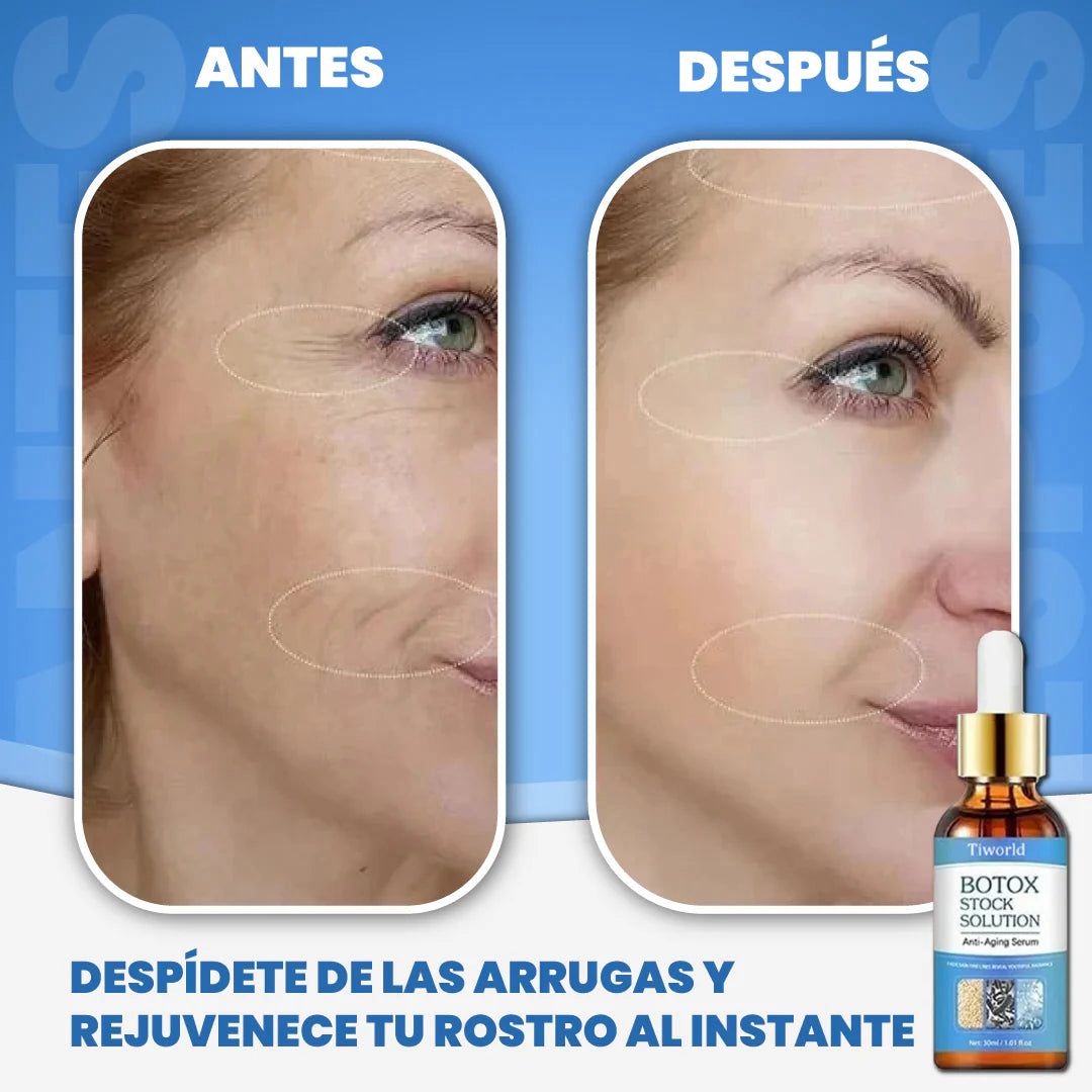 2x1 ENVÍO GRATIS - BOTOX FACIAL PARA ARRUGAS