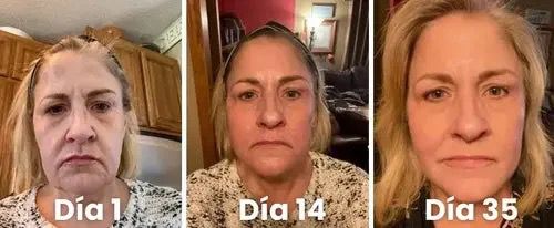 2x1 ENVÍO GRATIS - BOTOX FACIAL PARA ARRUGAS