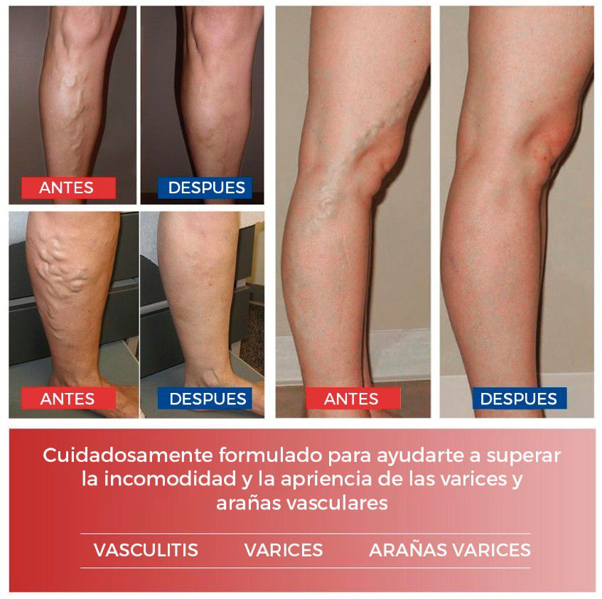 ✨PARCHES PARA VARICES✨